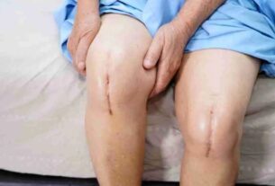 Knee Replacement Surgery