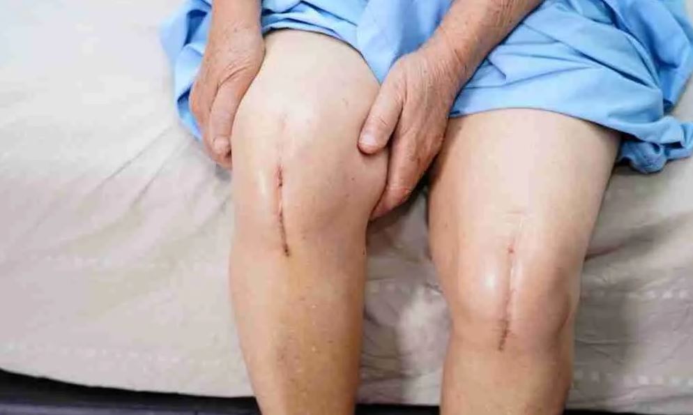 Knee Replacement Surgery