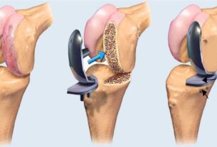 Joint Replacement Surgery