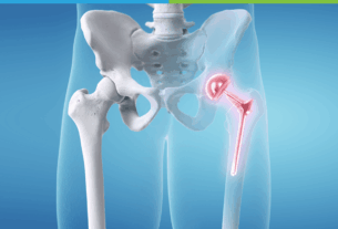 Joint Replacement Surgery