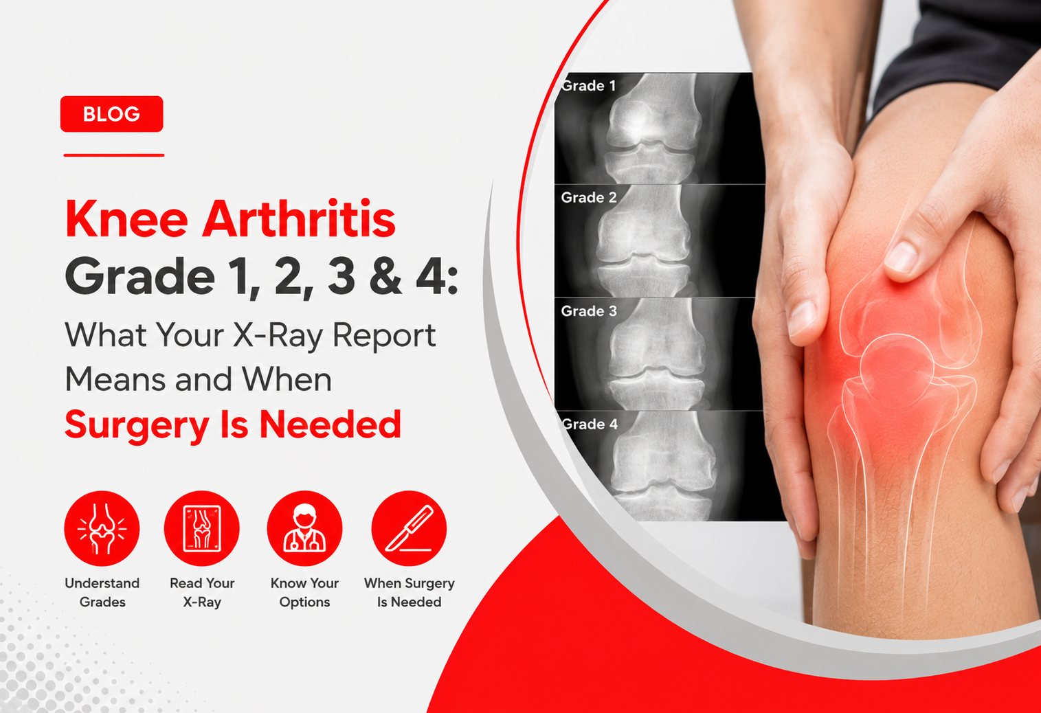 Knee Arthritis Grade 1, 2, 3 & 4